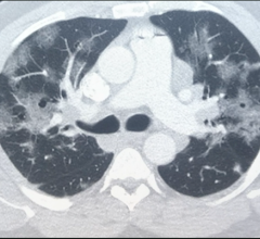 COVID-19 patient CT scan showing numerous ground glass lesions associated with SARS-CoV-2 pneumonia. 