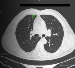 Infervision's newly FDA approved CT lung AI application sets a new standard