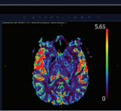 The above image shows a quantitative rCBV map, automatically generated within the Arterys platform