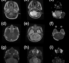 Example MR images from paediatric brain tumour patients. This first column shows T1-weighted images following the injection of gadolinium contrast agent. The second column shows T2-weighted images and the final column shows apparent diffusion coefficient maps calculated from diffusion-weighted images. (a–c) are taken from a patient with a Pilocytic Astrocytoma, (d–f) are from a patient with an Ependymoma and (g–i) were acquired from a patient with a Medulloblastoma.