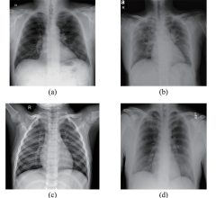 Samples from the dataset used in this study. (a) X-ray with PA view of a patient with COVID-19; (b) X-ray with AP view of a patient with COVID-19; (c) X-ray of a healthy patient from Dataset A; (d) X-ray of a healthy patient from Dataset B.