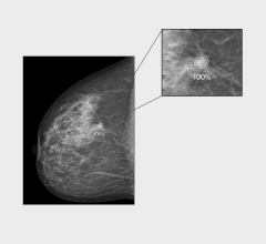  iCAD, Inc. announced that ProFound AI for 2D Mammography might notably reduce the risk of interval breast cancer, according to a retrospective analysis recently published in the Journal of Medical Screening. 