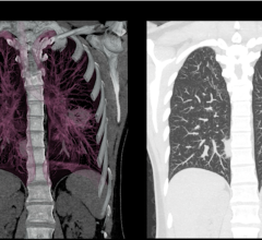 Patients with primary lung cancer detected using low-dose computed tomography screening are at reduced risk of developing brain metastases after diagnosis, according to a study published in the Journal of Thoracic Oncology.