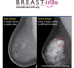DenseBreast-info.org (DB-I) announced that the European Society of Radiology (ESR) now links to DB-I website and educational materials as a resource for members about the screening and risk implications of dense breast tissue.