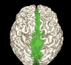 MRI showing the dorsal flow of the brain’s waste clearance system (shown in green). Image courtesy of Dr. Onder Albayram, Medical University of South Carolina