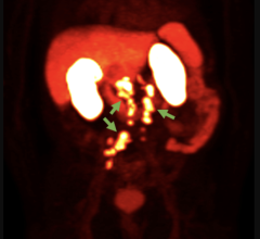 18F-rhPSMA-7.3 PET image showing prostate cancer spread beyond the prostate region (Photo courtesy of Blue Earth Diagnostics)