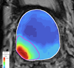 The study found considerable promise for Avenda Health’s machine learning model, Unfold AI, showing it to be effective in encapsulating all of the clinically significant cancer within the prostate (80%) over current standard of care (56%) 