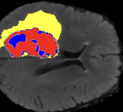 AI-annotated medical image showing enhanced tumor, tumor core and edema regions. Image courtesy of Monash University 