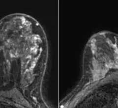 A machine learning model found that background parenchymal enhancement (BPE) on breast MRI is an indicator of breast cancer risk in women with extremely dense breasts