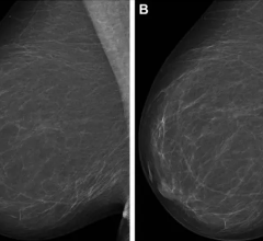 Full-field digital mammograms (right mediolateral oblique view)