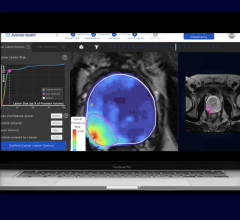 Reimbursement code improves access to personalized prostate cancer care with Avenda Health’s AI cancer mapping platform, Unfold AI  