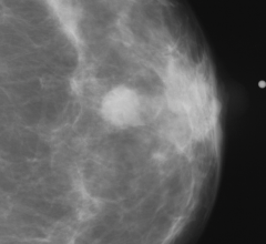 Abnormal mammogram.