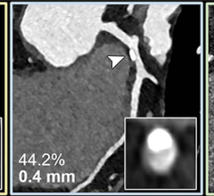 Ultrahigh-spatial-resolution photon-counting detector CT improved assessment of coronary artery disease (CAD), allowing for reclassification to a lower disease category in 54% of patients