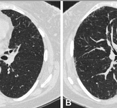A recently-published study, found that in individuals with a history of smoking, progression of quantitative interstitial abnormalities (QIA) at CT was associated with severe acute respiratory events, independent of comorbidities, such as emphysema and small airway disease.