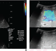 12-Year-Old Boy With Chronic Budd-Chiari Syndrome, Presenting With Recurrent Abdominal Pain and Distention, After Undergoing Left Hepatic Vein Angioplasty. 