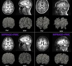 T1 structural images for the two sequences, MPRAGE and MPRAGE+PMC. The top row shows the MPRAGE sequence, while the bottom row shows the images that were generated with the MPRAGE+PMC sequence. Columns represent two different participants, one with minimal head motion (left, Low-Mover) and another with a large quantity of motion (right, High-Mover). Pial and white matter (WM) surface reconstruction from Freesurfer are also shown.