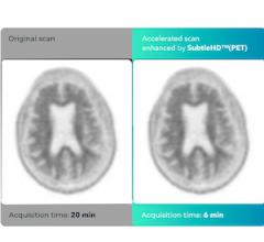 FDA Clears Subtle Medical's Image Acceleration, Enhancement Software
