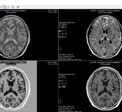 SyMRI Software Receives FDA Clearance for Use With Siemens MRI Systems