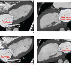 Cardiac CTA derived left atrium emptying fraction (LAEF) improves predictive performance of established clinical risk scores and may be used to assess TAVR patient risk during pre-procedure workup and post-procedural surveillance. These images show LAVmax (A and B), LAVmin (C and D), and LAEF using cardiac CTA. LAEF was calculated as (LAVmax-LAVmin)/LAVmax x 100. Given LAVmax of 109 mL and LAVmin of 80 mL, the LAEF was calculated to be 27%. Image courtesy of AJR.