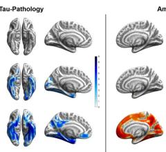 Tau (blue) and amyloid (orange) distribution patterns for super-agers, normal-agers and MCI patients, when compared to a group of younger, healthy, cognitively normal, amyloid-negative individuals. Brain projections are depicted at an uncorrected significance level of p < .0001. Color bars represent the respective t-statistic. Image courtesy of Merle C. Hoenig, Institute for Neuroscience and Medicine II - Molecular Organization of the Brain, Research Center Juelich, Juelich, Germany, and Department of Nucle