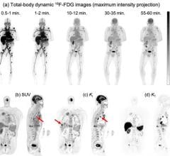 Total-body dynamic 18F-FDG PET imaging with the uEXPLORER scanner allows us to monitor the spatiotemporal distribution of glucose concentration in metastatic tumors in the entire body (a). As compared to a typical clinical standardized uptake value image (b), the parametric image of FDG influx rate (Ki) can achieve higher lesion-to-background (e.g., the liver) contrast. In addition to glucose metabolism imaging by Ki, total-body dynamic PET also enables multiparametric characterization of tumors and organs 