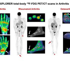 Left: Total-body PET/CT in psoriatic arthritis: multiple joints affected, shoulders, elbows, wrists, knees, ankles and small joints of the hands/feet. Arrow: left wrist; arrowhead: right wrist. Middle: Total-body PET/CT in rheumatoid arthritis: multiple joints affected, right shoulder, small joints of the left hand. Arrowhead at the 4th proximal interphalangeal joint shows classic ring-like uptake pattern. Arrow on the foot images demonstrates the hammer toe deformity besides big toe arthritis. Right: Total