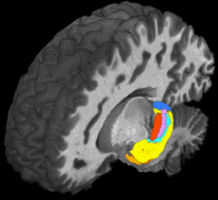 Using ultra-high field magnetic resonance imaging (MRI) to map the brains of people with #Down_syndrome (#DS), #researchers from #CaseWesternReserveUniversity, #ClevelandClinic, University Hospitals and other institutions detected subtle differences in the structure and function of the #hippocampus—a region of the #brain tied to memory and learning.
