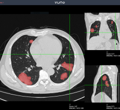#COVID19 #Coronavirus #2019nCoV #Wuhanvirus #SARScov2 the company is now offering a suite of AI solutions Vuno Med-LungQuant and Vuno Med-Chest X-ray for COVID-19, encompassing both lung X-ray and computed tomography (CT) modalities respectively all at once