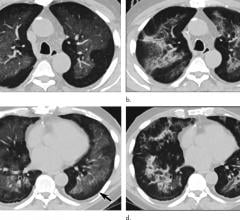 Electronic cigarette or vaping product use-associated lung injury in a 51-year-old man manifesting as an acute lung injury pattern at CT with subsequent organization. 
