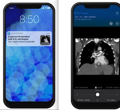 An example of Viz.AI's pulmonary embolism AI application and mobile alert to the physician on-call. Viz.AI and Avicenna.AI Partner to Launch Artificial Intelligence Care Coordination for Pulmonary Embolism and Aortic Disease