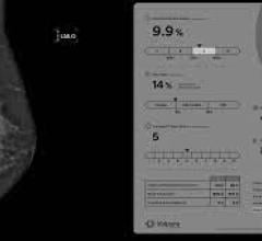 Volpara Analytics uses AI to measure mammography positioning, compression, and dose