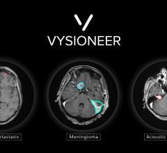 Brain tumors edged out by artificial intelligence: VBrain applies auto-contouring to the three most common types of brain tumors: brain metastasis, meningioma and acoustic neuroma.