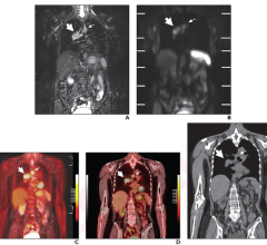 Per reference-standard diagnosis, TNM stage was IIIA (T3N2M0) and Veterans Administration Lung Cancer Study Group stage was LS. Coronal (A) STIR image and (B) DWI from whole-body MRI.