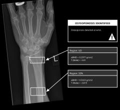 A groundbreaking solution for osteoporosis screening has been announced by medical X-ray technology pioneer IBEX Innovations Ltd. 