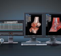 Fovia and iCRco Deliver High Definition Volume Rendering to the Orthopedic Market
