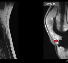 Mavric MRI GE Healthcare