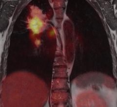 Imaging agent helps predict success of lung cancer therapy