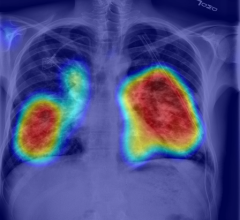 RADLogics AI-Powered solution in use: chest X-ray of COVID-19 positive case with heatmap key image.