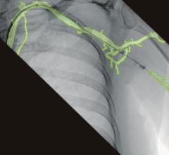 An example of the 3-D vascular roadmapping technology on the Ziehm mobile C-arm systems.