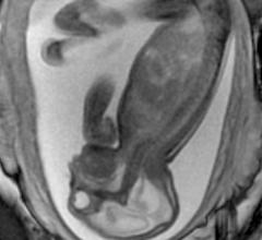 Prenatal MRI of a Zika fetus showing enlarged cerebral fluid space, dilation of the cerebral ventricles, thinning of brain tissue, poorly developed cerebellum and the absence of brain cortical gyri. (Image coutesy of RSNA)