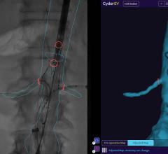 Cydar EV Maps assists in the planning, real-time guidance, and post-procedure review of endovascular surgery.