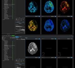 Random Walk Imaging AB (RWI), a company developing novel software solutions for diffusion magnetic resonance imaging (MRI), announced the launch of its first commercial software product for clinical researchers and radiologists.