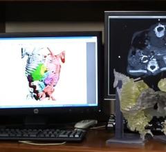 3-D printing, CT dataset, conjoined twins, surgical separation, physical model