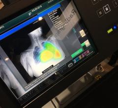 This is artificial intelligence on Fujifilm's mobile digital radiography system to immediately detect pneumothorax (a collapsed lung) and show the location to the technologist and attending physician in a unit before the image is even uploaded to the PACS for a read. AI applications like this that have immediate impact on critical patient care saw a lot of interest at RSNA 2019. 