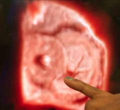 An example of Philips’ TrueVue technology, which offers photo-realistic rendering and the ability to change the location of the lighting source on 3-D ultrasound images. In this example of two Amplazer transcatheter septal occluder devices in the heart, the operator demonstrating the product was able to push the lighting source behind the devices into the other chamber of the heart. This illuminated a hole that was still present that the occluders did not seal.