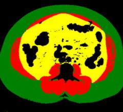 An example of a body composition analysis of an abdominal CT slice with the subcutaneous fat in green, skeletal muscle red and visceral fat in yellow. This was automatically identified and analyzed via a deep learning algorithm to assess the risk for heart attack and stroke in more than 12,000 patients. #RSNA2020 #RSNA20 #RSNA