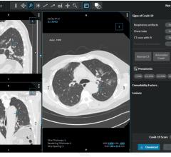 In the STOIC study, readers classified CT exams as COVID positive, COVID negative or normal. The readers had access to the CT scans using a 3D image visualization web application, allowing scrolling through the entire lung volume in the coronal, sagittal or axial transverse plane. The CT scan shown here has been classified as COVID positive due to the presence of bilateral ground glass opacities and absence of features such as mucoid impaction, bronchiolar nodules, segmental, lobar consolidation. RSNA Image