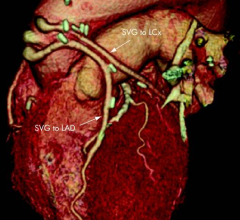 ct systems angiography clinical trial study CTA 320 anio core
