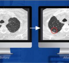 Studies conducted by Mass General Hospital and University of Virginia have concluded that PixelShine, a disruptive technology from AlgoMedica, significantly improved the diagnostic quality of CT scans acquired at reduced radiation dose. Here, you can see before and after noise reduction is applied.