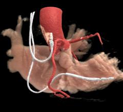 A cardiac CT of a patient with pacemaker leads, which can be challenging to get good images due to metal artifact. This image was rendered from using Canon's AiCE AI-assisted interactive reconstruction with Global Illumination 3-D rendering from a scan on an Aquilion One Genesis SP system.